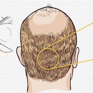 İstanbul doğal saç ekim merkezi