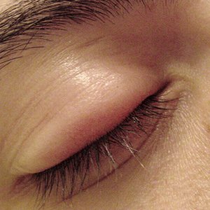 İt Dirseği (Arpacık) Nedir? İt Dirseği Belirtileri