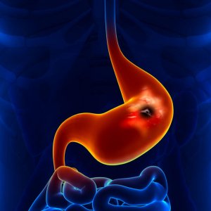 Onikiparmak Bağırsağı Ülseri Belirtileri ve Tedavisi