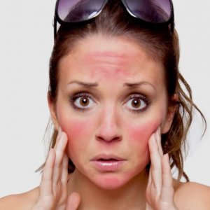 Yüzdeki Güneş Yanığı Lekeleri Kaç Günde ve Nasıl Geçer